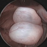 Histeroskopi ile rahim içinde 2 adet polip görünümü