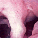 Histeroskopi ile septum görünümü.Doğuştan rahim odacığı 2 ye ayrılmış 