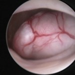 Histeroskopi ile rahim içinde Myom görünümü
