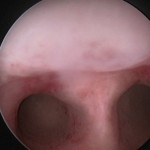 Histeroskopi ile rahim içinde 2 odacık görünümü.Uterus Subseptus