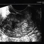 Rahim içindeki myomun ultrasonografi ile görünümü. Tedavisi histeroskopi ile myom kesilmesidir.