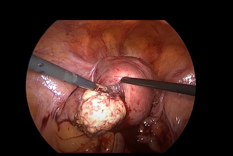 Jinekolojik Operasyonlar-Myom